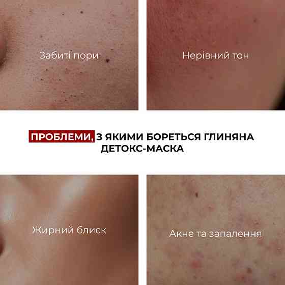 Набір для очищення та боротьби з акне Hillary Anti-Acne & Detox Skin Set Київ
