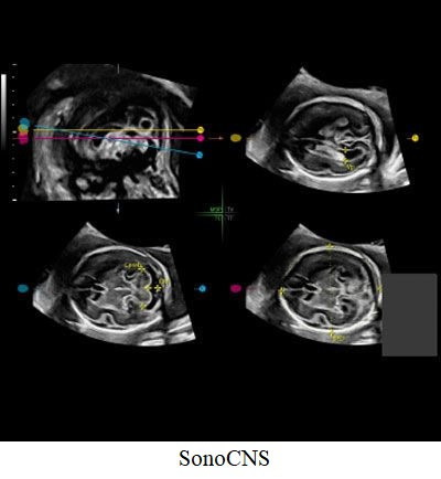 Ультразвуковий апарат (УЗД) Voluson™ S8 Touch Дніпро - фото 6