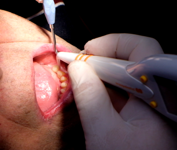 Пародонтальный зонд pa-on, OrangeDental Днепр - изображение 10