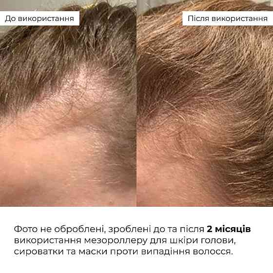 Мезороллер для шкіри голови Hillary + Сироватка та маска проти випадіння волосся Київ