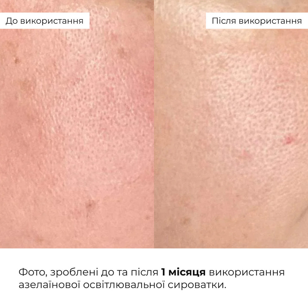 Набор для увлажнения и осветления тона кожи лица с азелаиновой кислотой Hillary Hydration & Azelaic Brightening Set Киев - изображение 13