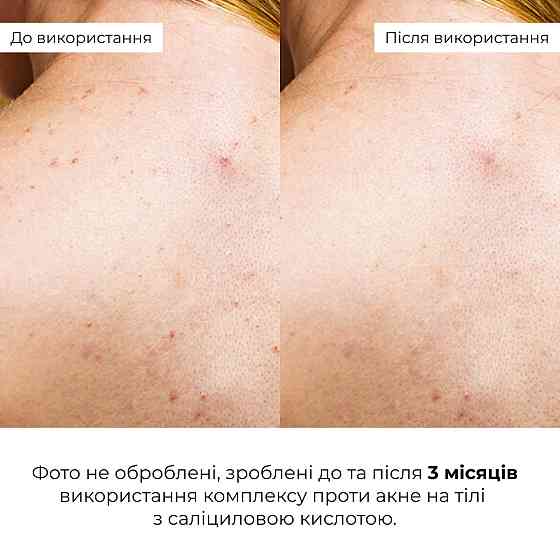 Комплекс тройного удара против акне на теле с салициловой кислотой Hillary Triple-Action Body Acne Control Complex with Salicylic Киев