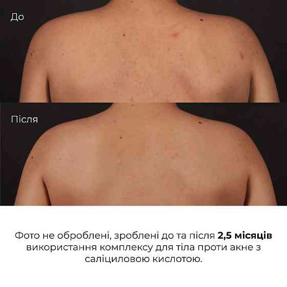 Комплекс проти висипань на тілі та глибокого живлення Hillary Body Acne & Deep Nourishment Complex Киев