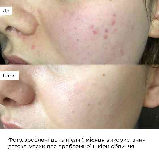 Глиняная детокс-маска для проблемной кожи лица Anti-Acne & Detox Clay Mask Hillary 90 мл Киев