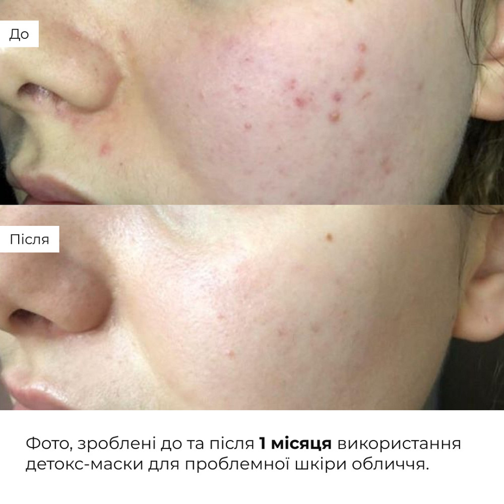 Глиняная детокс-маска для проблемной кожи лица Anti-Acne & Detox Clay Mask Hillary 90 мл Киев - изображение 18