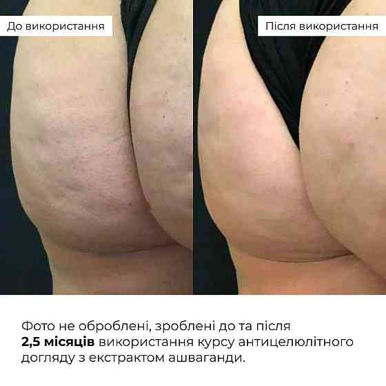 Курс антицеллюлитного ухода в домашних условиях с экстрактом ашваганды Hillary Ashwagandha Anti-Cellulite Care Киев