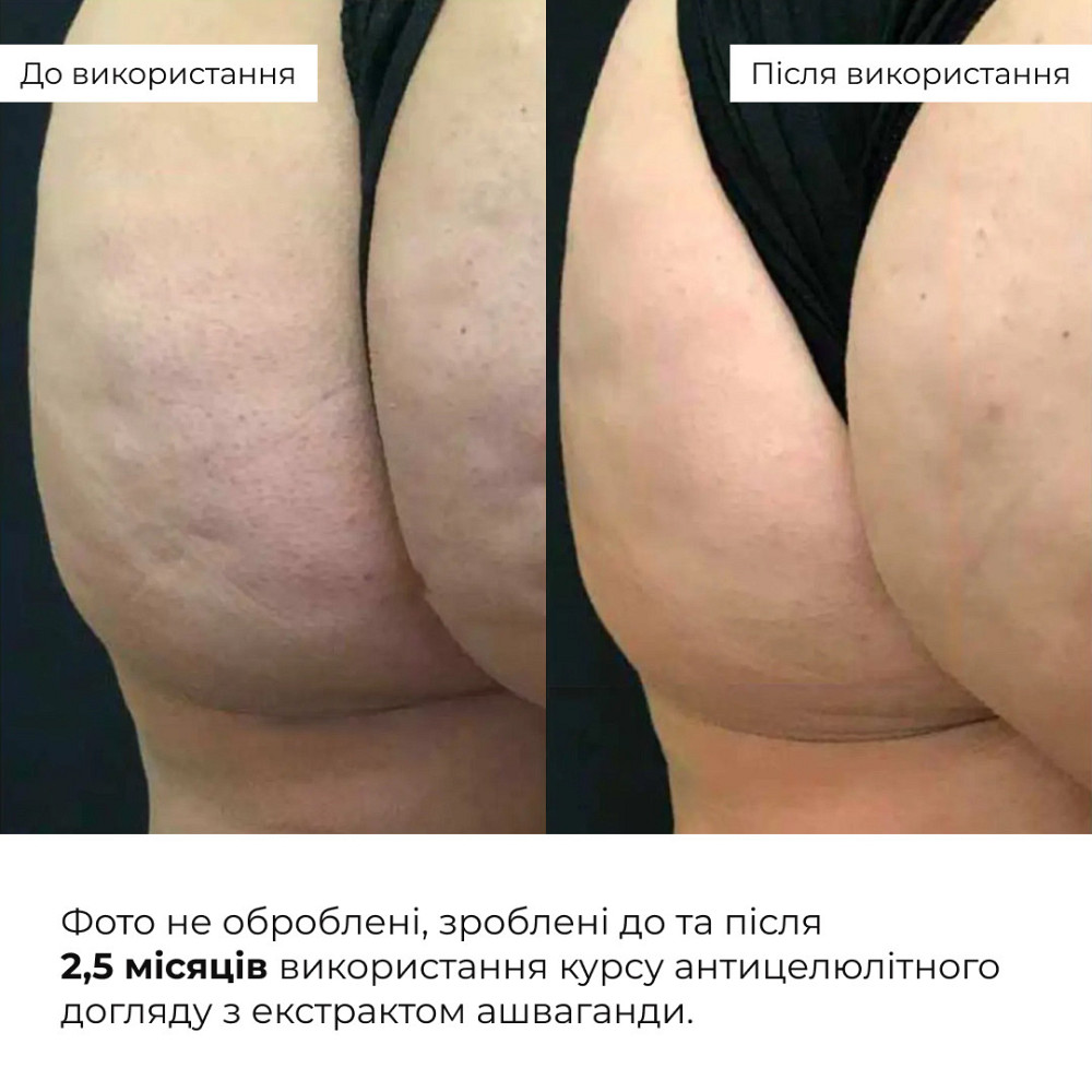 Курс антицеллюлитного ухода в домашних условиях с экстрактом ашваганды Hillary Ashwagandha Anti-Cellulite Care Киев - изображение 4