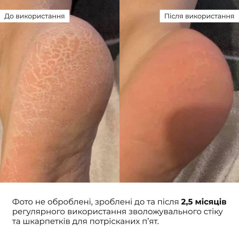 Набір для зволоження та пом'якшення потрісканих п’ят Hillary Set for Moisturizing & Softening Cracked Heels Київ - фото 2