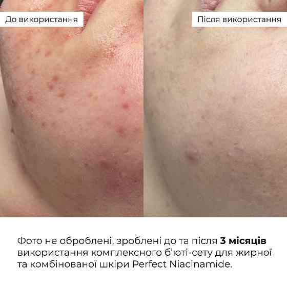 Комплексный бьюти-сет для жирной и комбинированной кожи Perfect Niacinamide Sebo Balance Hillary Киев