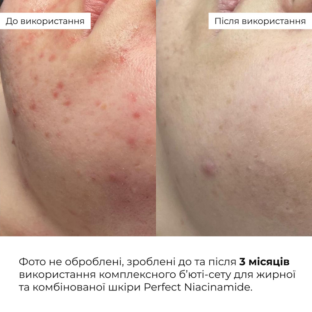 Комплексный бьюти-сет для жирной и комбинированной кожи Perfect Niacinamide Sebo Balance Hillary Киев - изображение 3