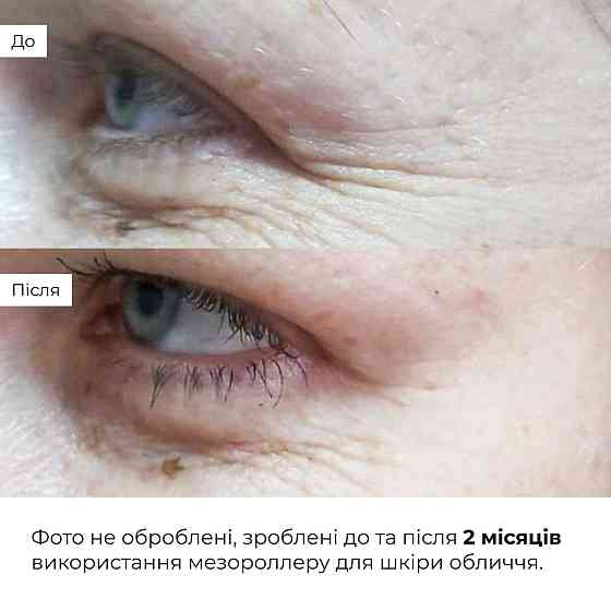 Гіалуронова сироватка Hillary Smart Hyaluronic, 30 мл + Мезороллер для обличчя Hillary Київ