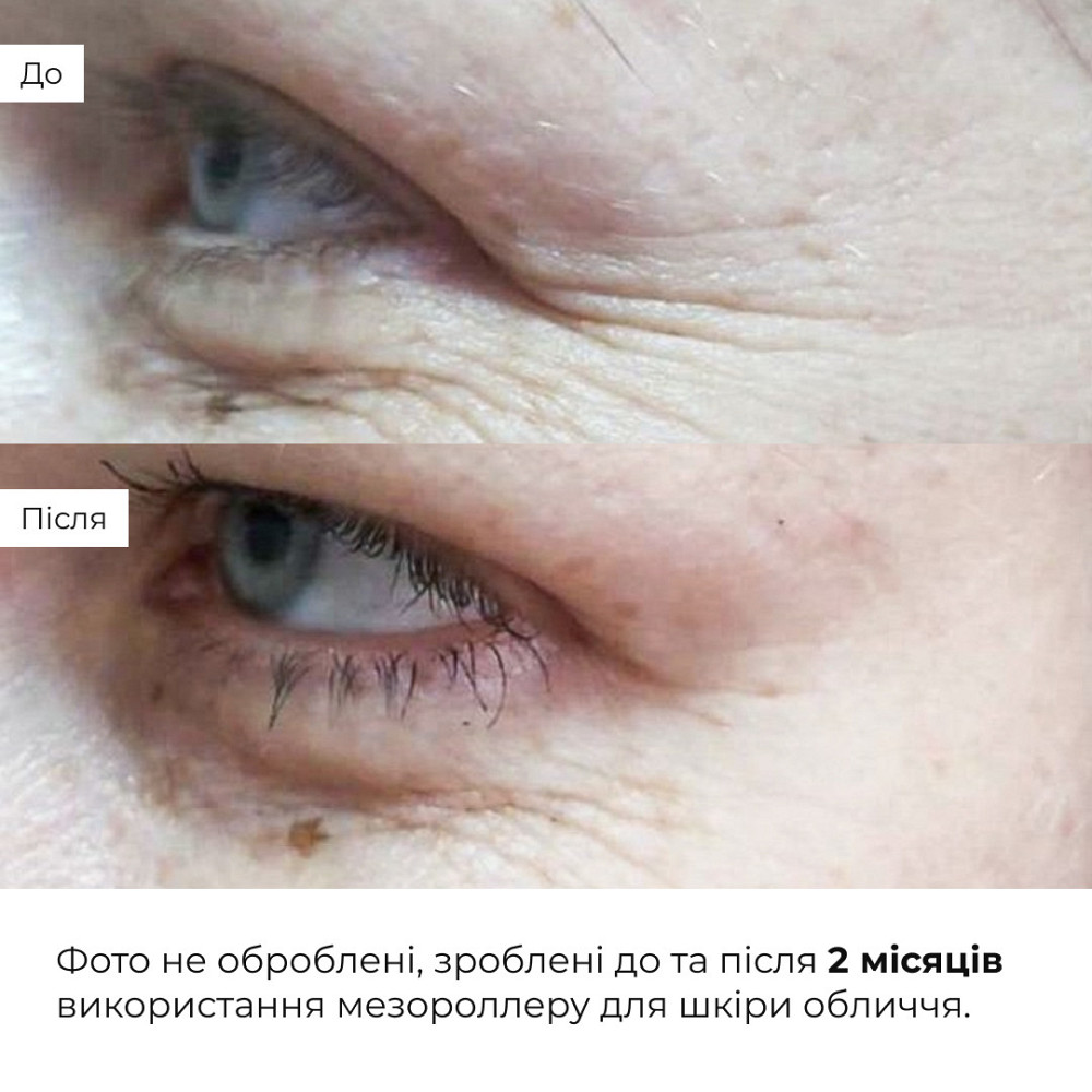 Гіалуронова сироватка Hillary Smart Hyaluronic, 30 мл + Мезороллер для обличчя Hillary Київ - фото 2