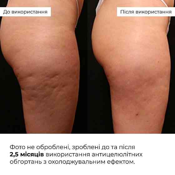 Антицелюлітні обгортання з охолоджувальним ефектом Hillary Anti-cellulite Bandage Cooling Effect Київ