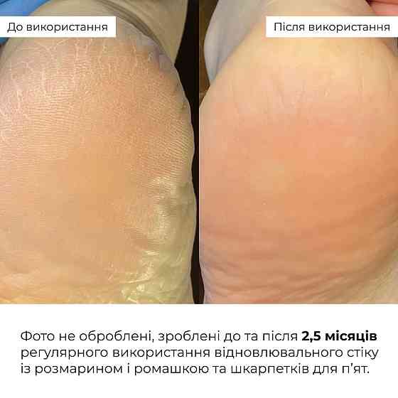 Набір для потрісканих п’ят із розмарином та ромашкою Hillary HydraHeel Repair & Comfort Set Київ