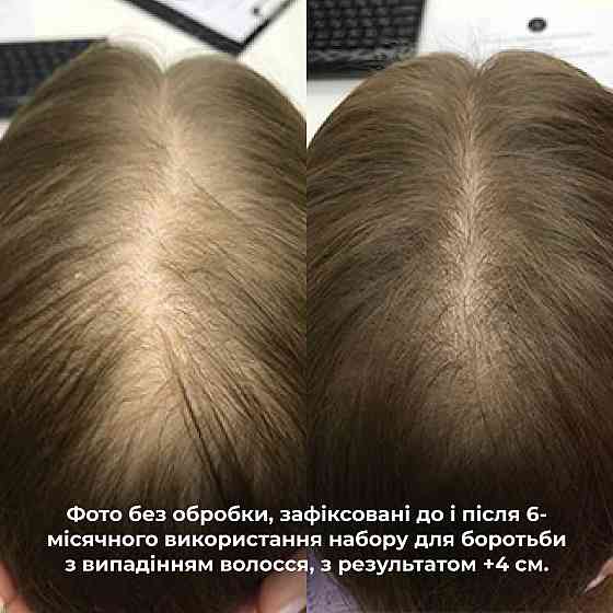 Комплекс Serenoa & РР Hair Loss Control + Натуральная маска Bamboo Киев