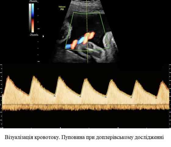 Ультразвуковий апарат (УЗД) Voluson™ P8 Дніпро
