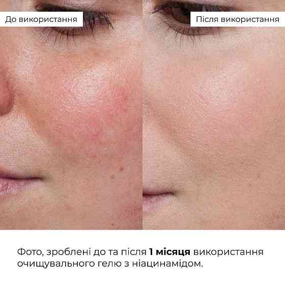 Набор для уменьшения жирности и воспалений с ниацинамидом Hillary Anti-Blemish Niacinamide Set Киев