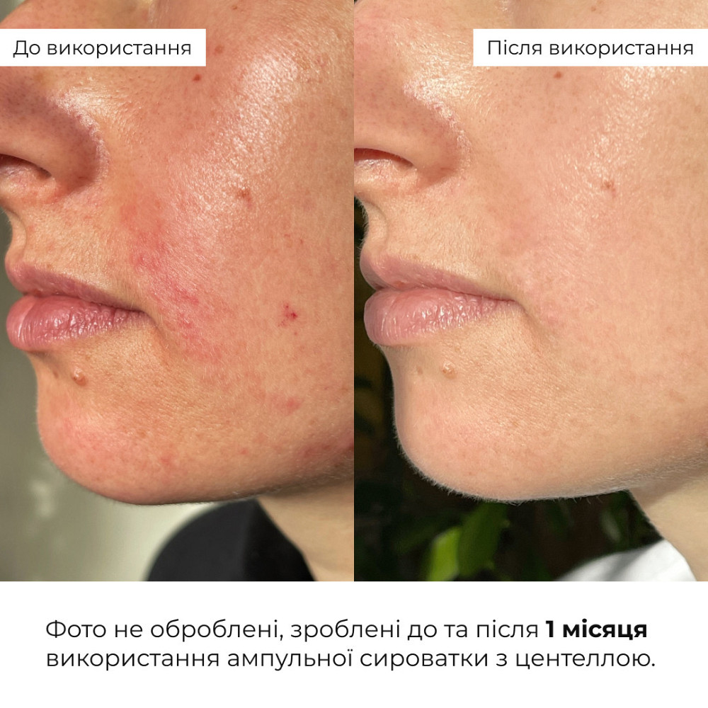Набор для успокоения кожи и поддержки защитного барьера Hillary Soothing & Skin Barrier Support Set Киев - изображение 2