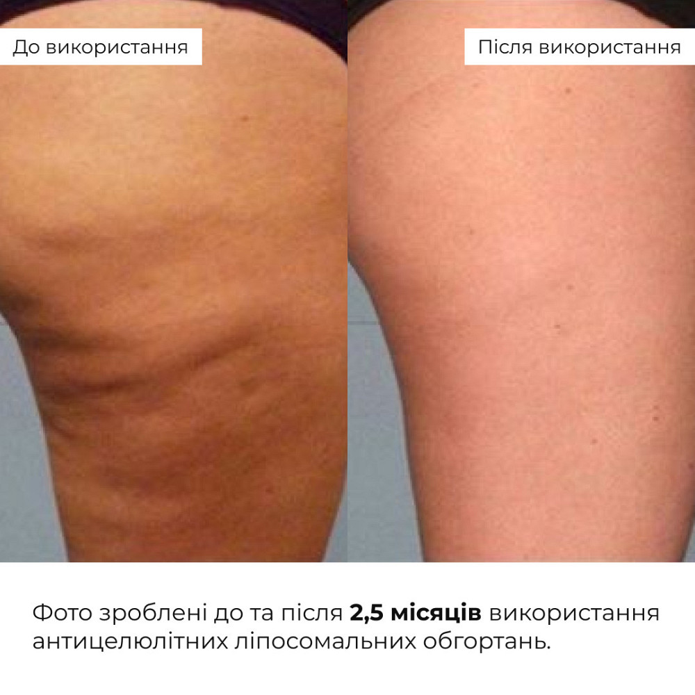 Курс Антицеллюлитных липосомальных обертываний Hillary Anti-cellulite Bandage LPD'S Slimming (6 уп,) Киев - изображение 14