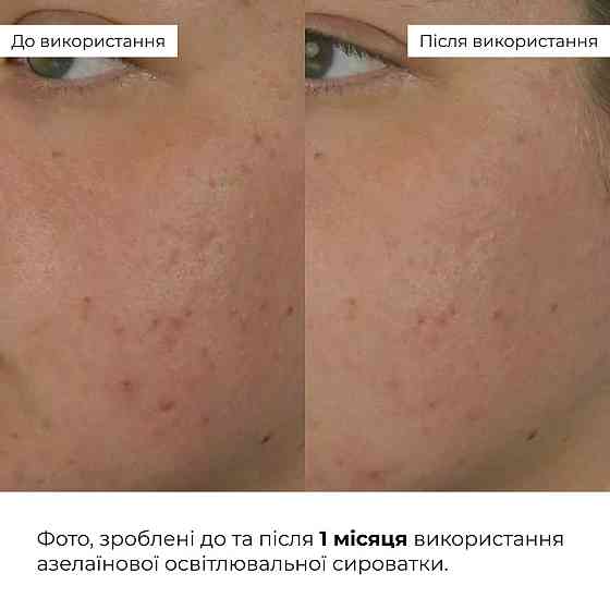 Набір відновлення після запалень та постакне Hillary Recovery Set for Post-Inflammation & Post-Acne Киев