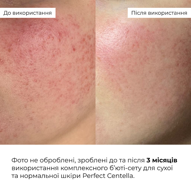 Комплексный бьюти-сет для сухой и нормальной кожи Perfect Centella Deep Hydration Hillary Винница - изображение 3