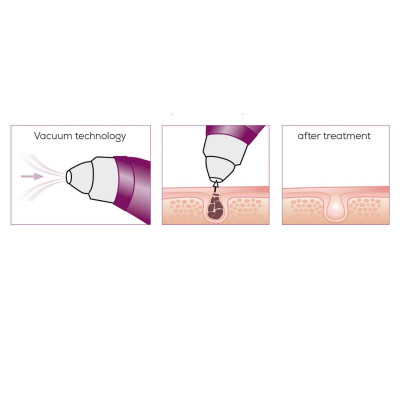 Прибор для чистки кожи лица Beurer FC 41 Винница - изображение 11