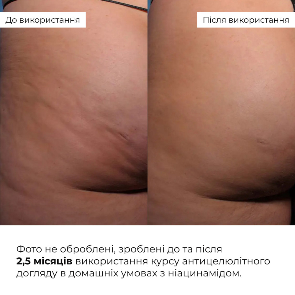 Курс антицелюлітного догляду в домашніх умовах з ніацинамідом Niacinamide Anti-Cellulite Home Care Hillary Київ - фото 20