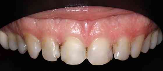 Объектив Стоматология, Природа Canon EF 100mm. F/2.8L Macro IS USM Киев