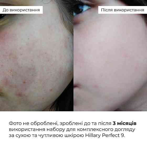 Набір для комплексного догляду за сухою та чутливою шкірою Hillary Perfect 9 Київ