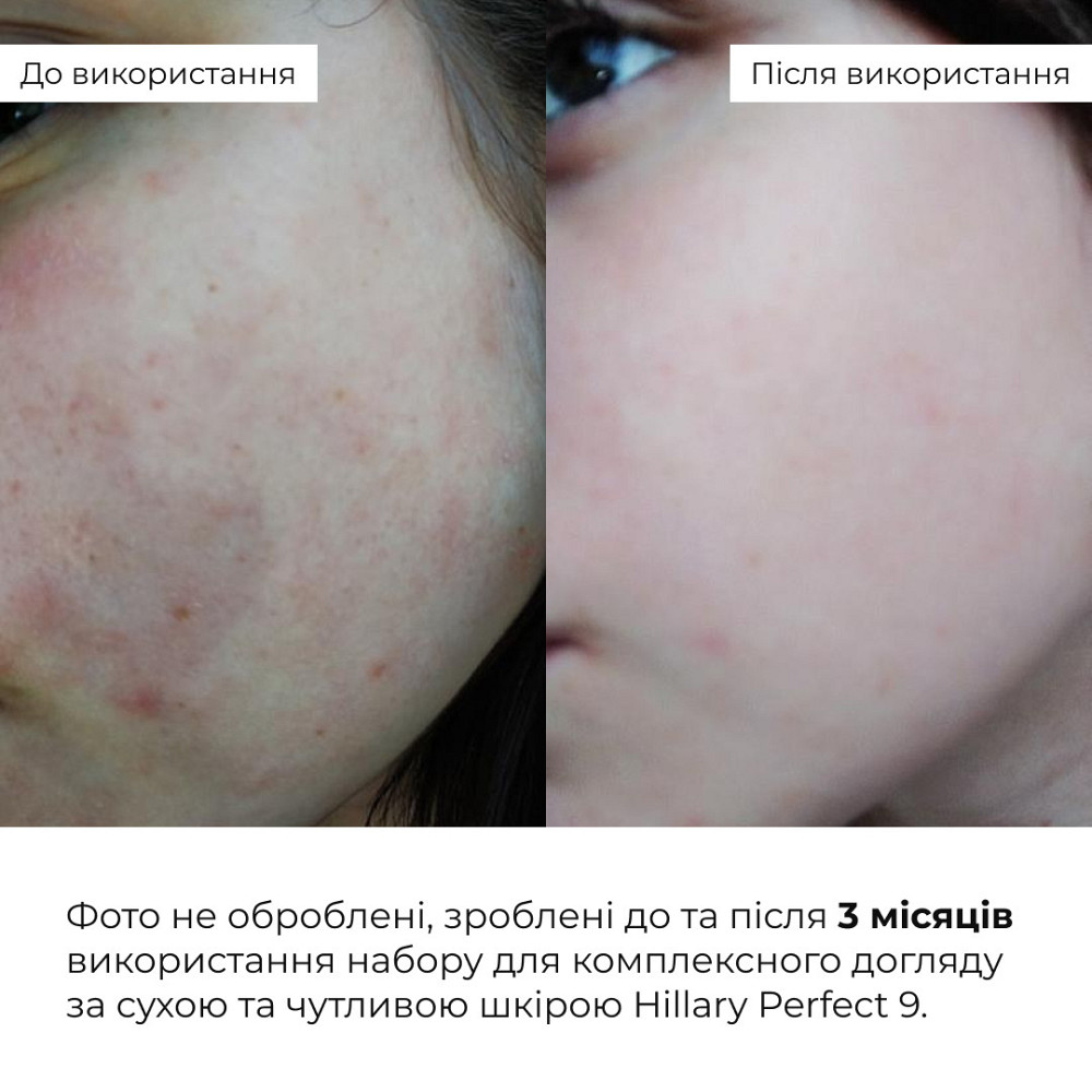 Набір для комплексного догляду за сухою та чутливою шкірою Hillary Perfect 9 Київ - фото 2