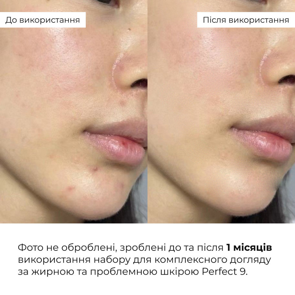 Набор для комплексного ухода за жирной и проблемной кожей Hillary Perfect 9 Киев - изображение 2