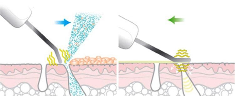 Скрабер для чистки и подтяжки лица ультразвуковой портативный+ Ионизация+ Антибактериальная терапия+ Сонофорез Днепр - изображение 6