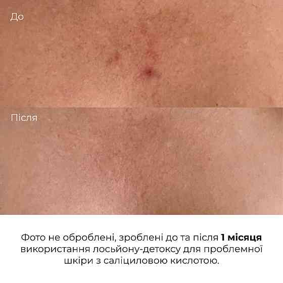 Лосьон-детокс для проблемной кожи с салициловой кислотой Hillary Anti-Acne Salicylic Body Lotion, 150 мл Киев