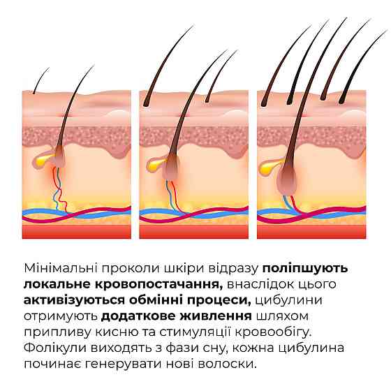 Мезороллер для шкіри голови + Комплекс для росту волосся Hop Cones & B5 Hair Growth Invigorating Київ