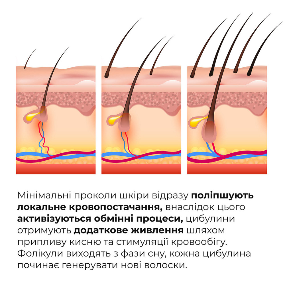 Мезороллер для шкіри голови + Комплекс для росту волосся Hop Cones & B5 Hair Growth Invigorating Київ - фото 4