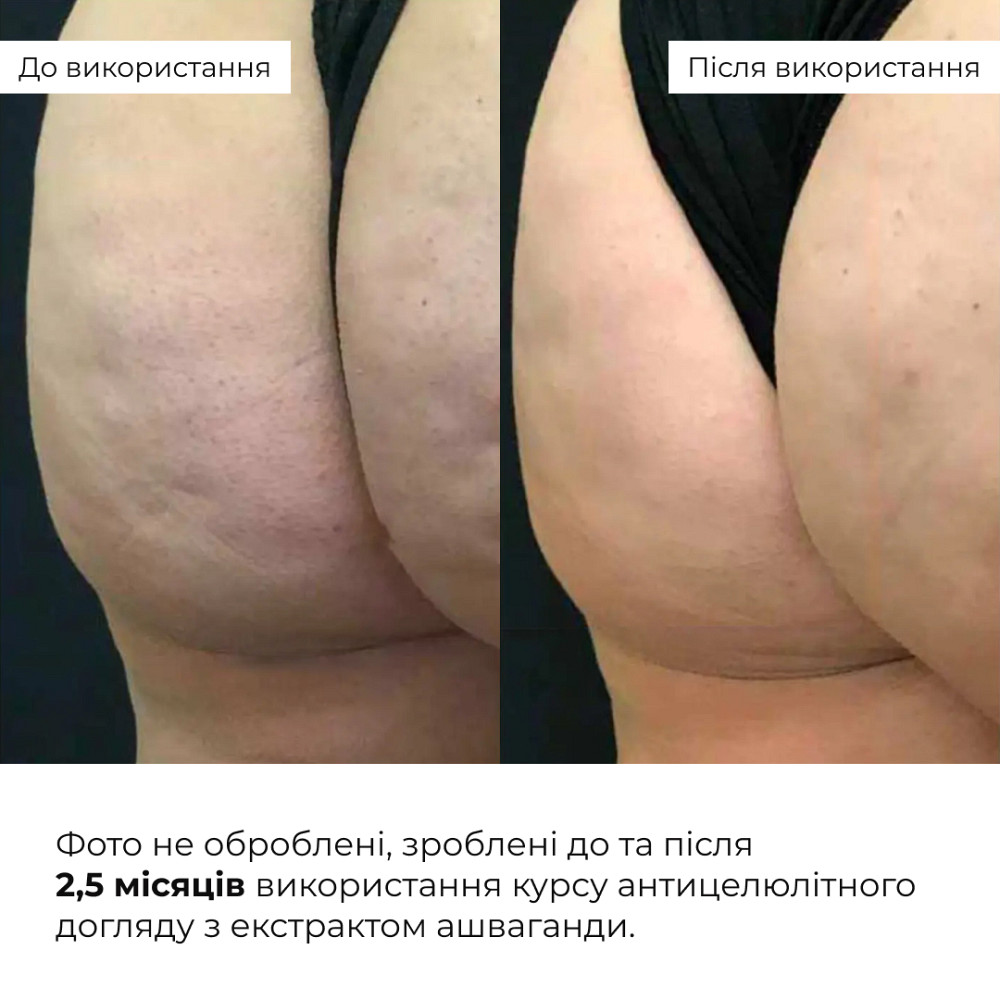 Курс антицелюлітного догляду в домашніх умовах з екстрактом ашваганди Ashwagandha Anti-Cellulite Care Hillary Київ - фото 19