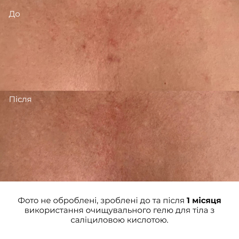Очищающий гель для тела с салициловой кислотой Anti-Acne Salicylic Body Wash Hillary 200 мл Киев - изображение 16