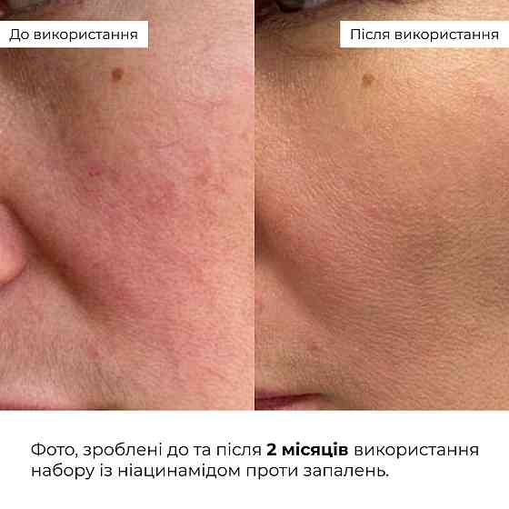 Набір із ніацинамідом проти запалень Hillary Niacinamide Anti-Inflammation Set Киев