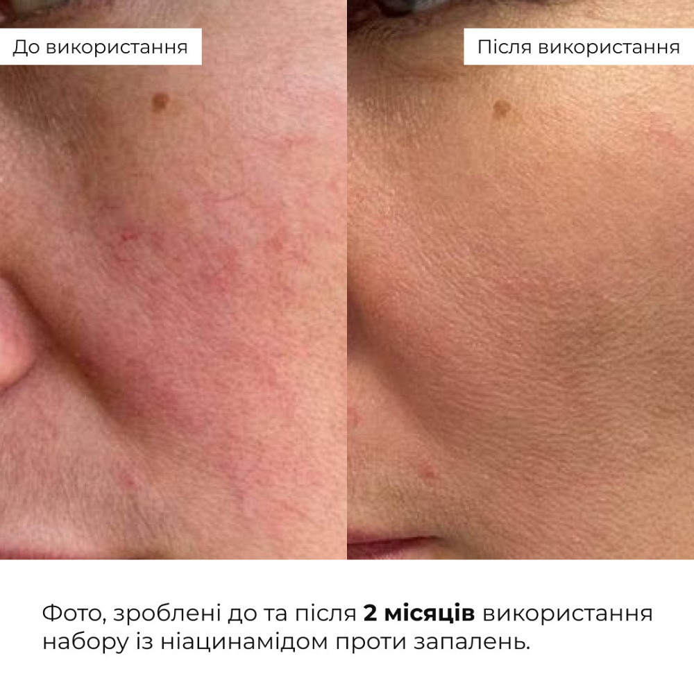 Набір із ніацинамідом проти запалень Hillary Niacinamide Anti-Inflammation Set Київ - фото 2