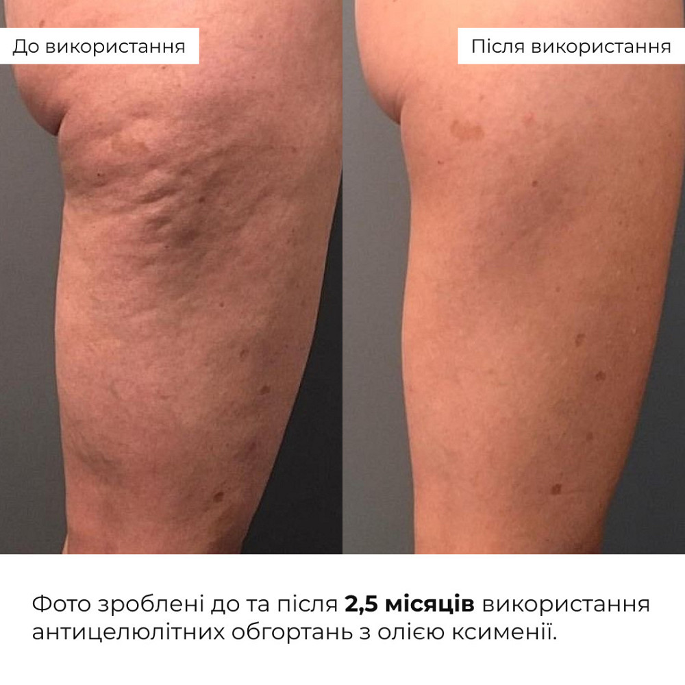 Антицелюлітні обгортання з олією ксименії Hillary Anti-cellulite Bandage African Ximenia Київ - фото 14