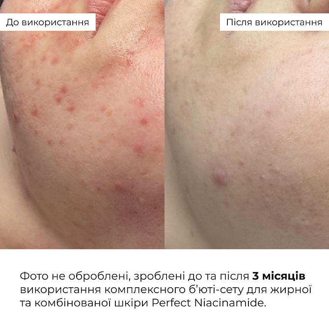Комплексний б’юті-сет для жирної та комбінованої шкіри Perfect Niacinamide Sebo Balance Hillary Вінниця - фото 3