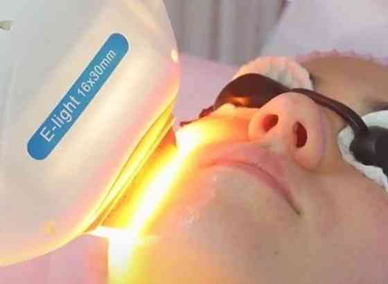 Аппарат Фотоэпиляции и фотоомоложения :IP-300. Киев