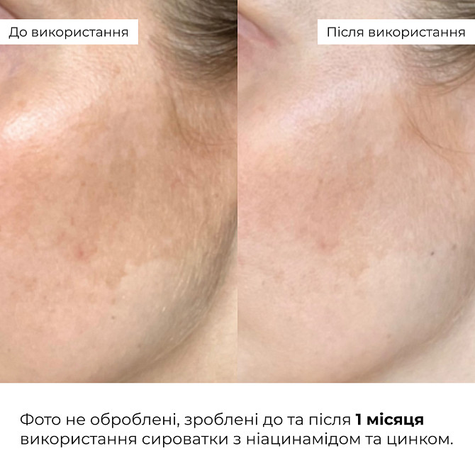 Комплексний б’юті-сет для жирної та комбінованої шкіри Perfect Niacinamide Sebo Balance Hillary Вінниця - фото 13