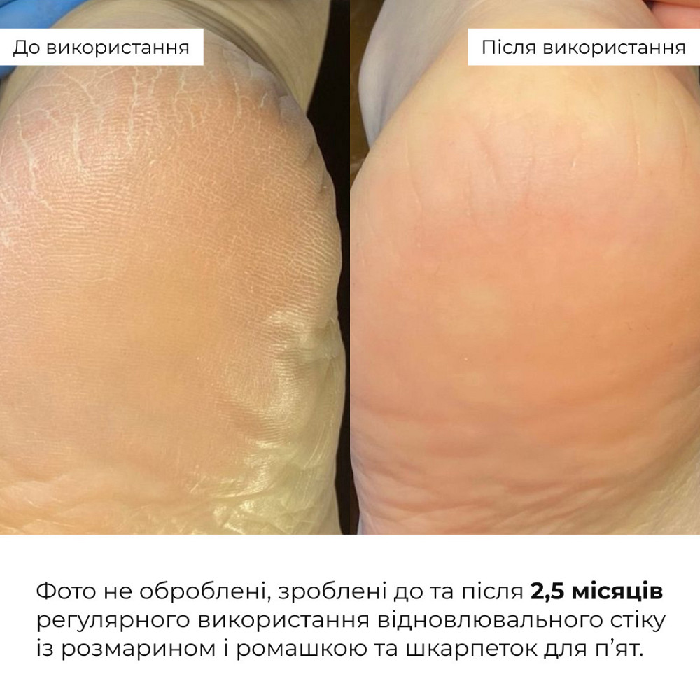 Набір для потрісканих п’ят із розмарином та ромашкою Hillary HydraHeel Repair & Comfort Set Київ - фото 11