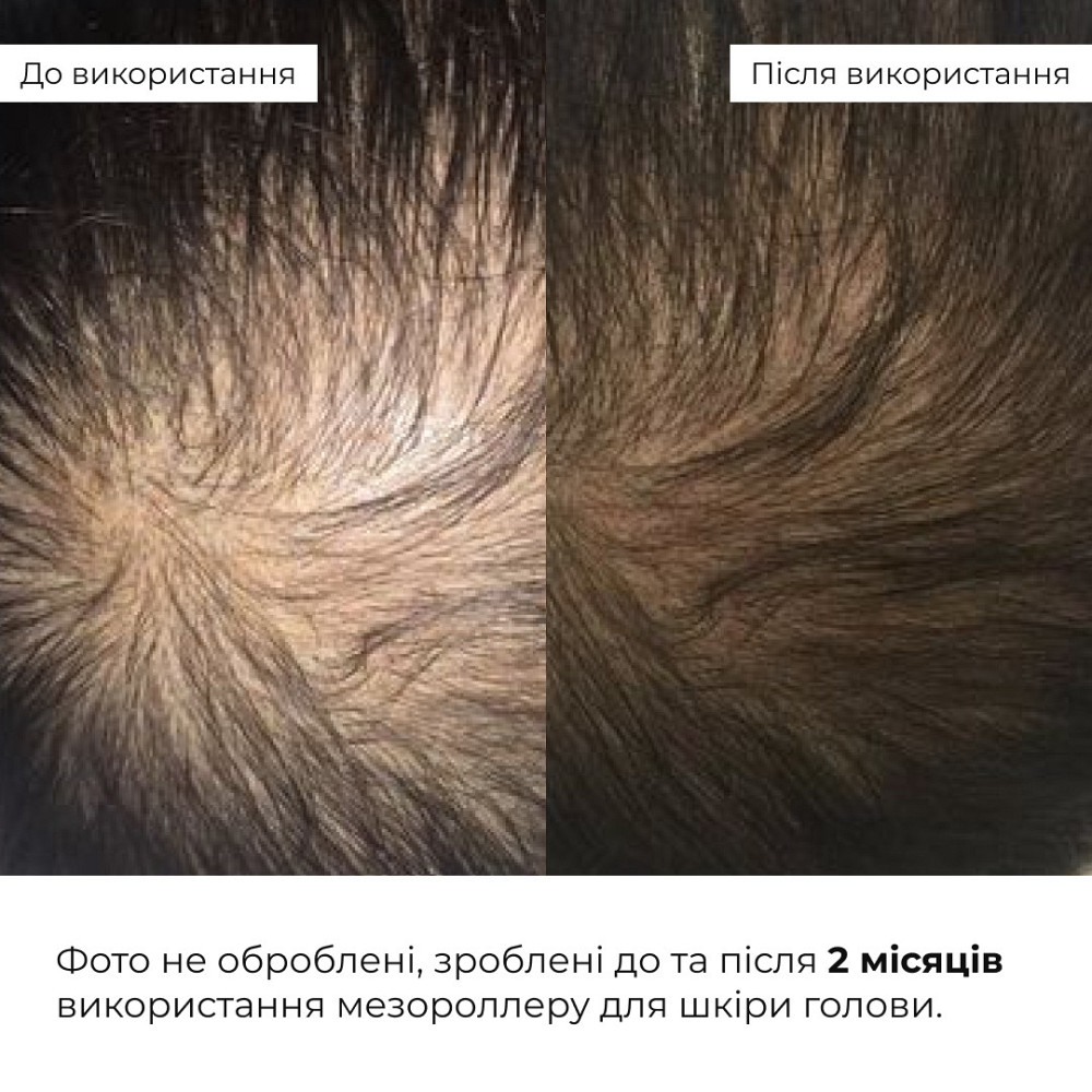 Мезороллер для шкіри голови Hillary + Сироватка для волосся MULTI-ACTIVE HOP CONES Київ - фото 2