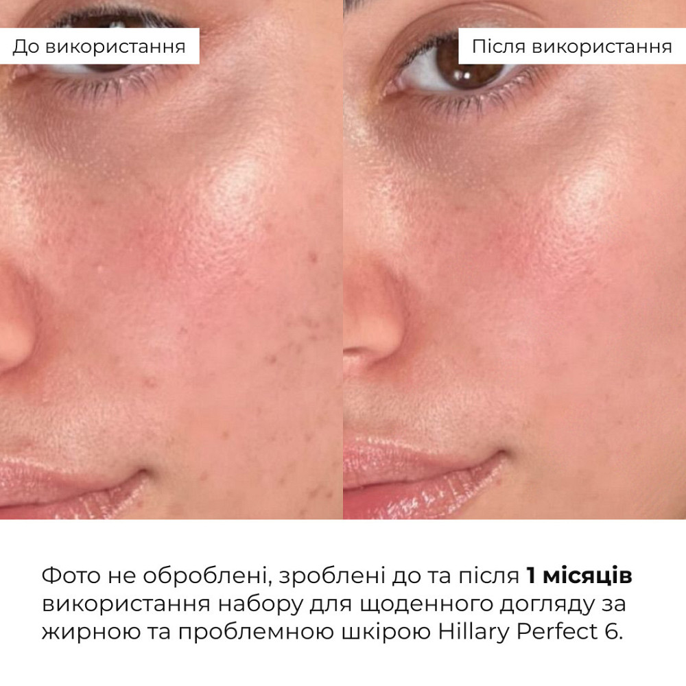 Набор для ежедневного ухода за жирной и проблемной кожей Hillary Perfect 6 Киев - изображение 2
