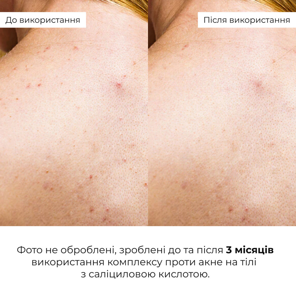 Комплект для боротьби з акне на тілі з саліциловою кислотою Salicylic Body Acne Treatment Set Hillary Київ - фото 8