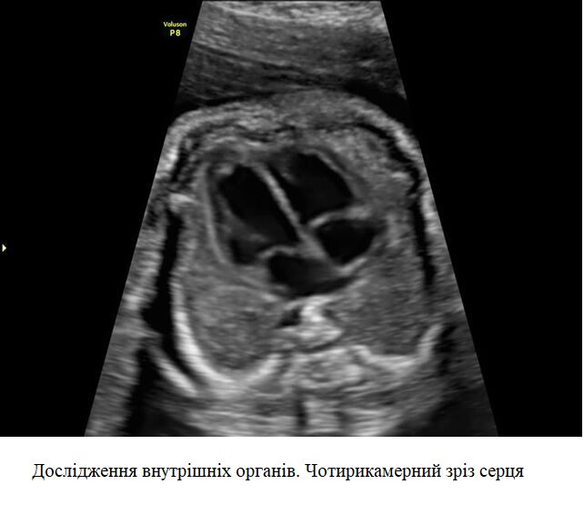 Ультразвуковой аппарат (УЗИ) Voluson™ P8 Днепр - изображение 8