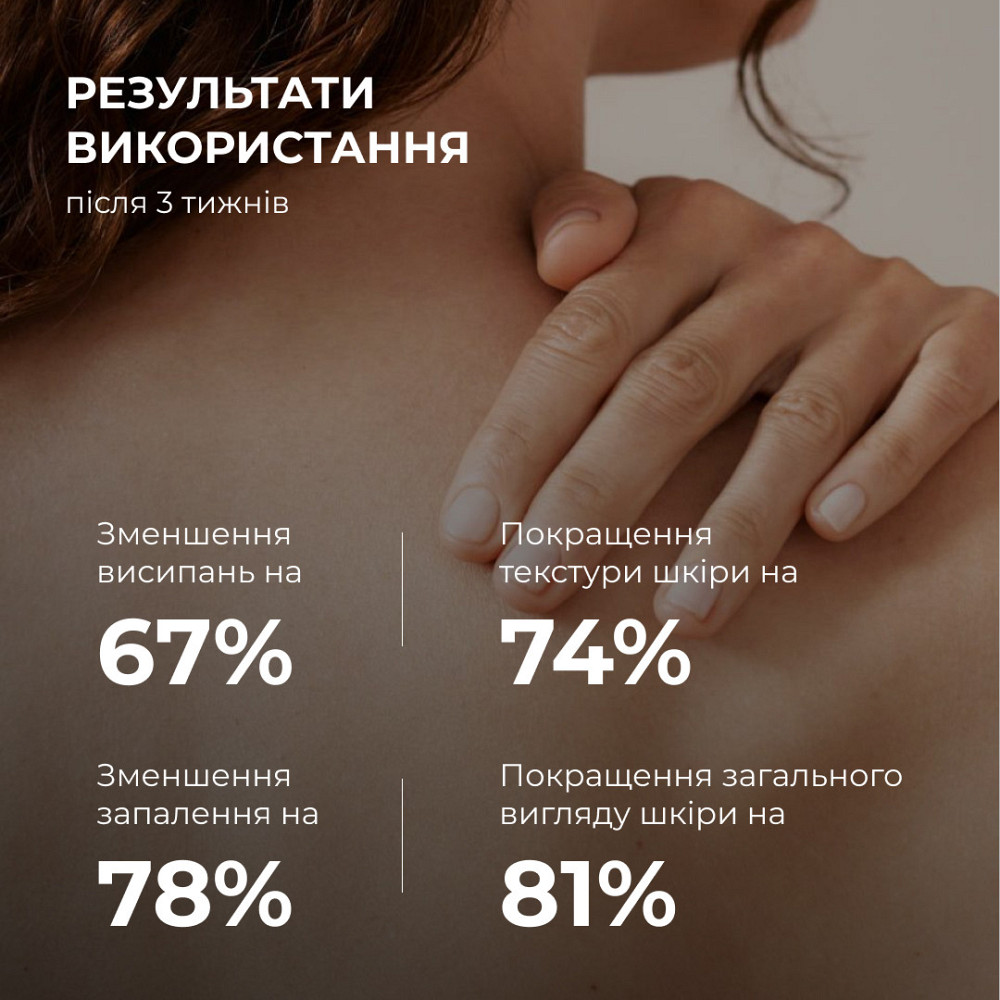 Комплекс тройного удара против акне на теле с салициловой кислотой Hillary Triple-Action Body Acne Control Complex with Salicylic Киев - изображение 5