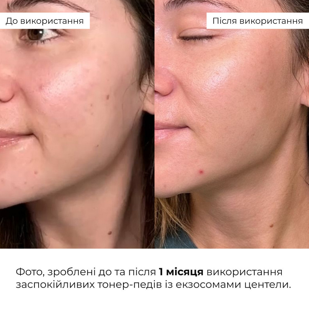 Набір для корекції темних кіл та подразнень Hillary Dark Circles & Irritation Correction Set Київ - фото 2
